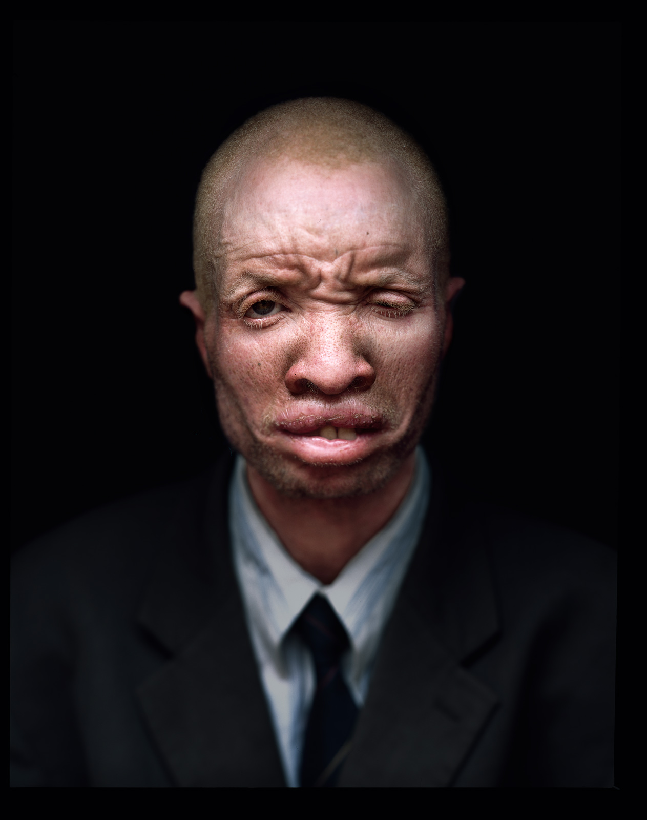People with Albinism, Malawi