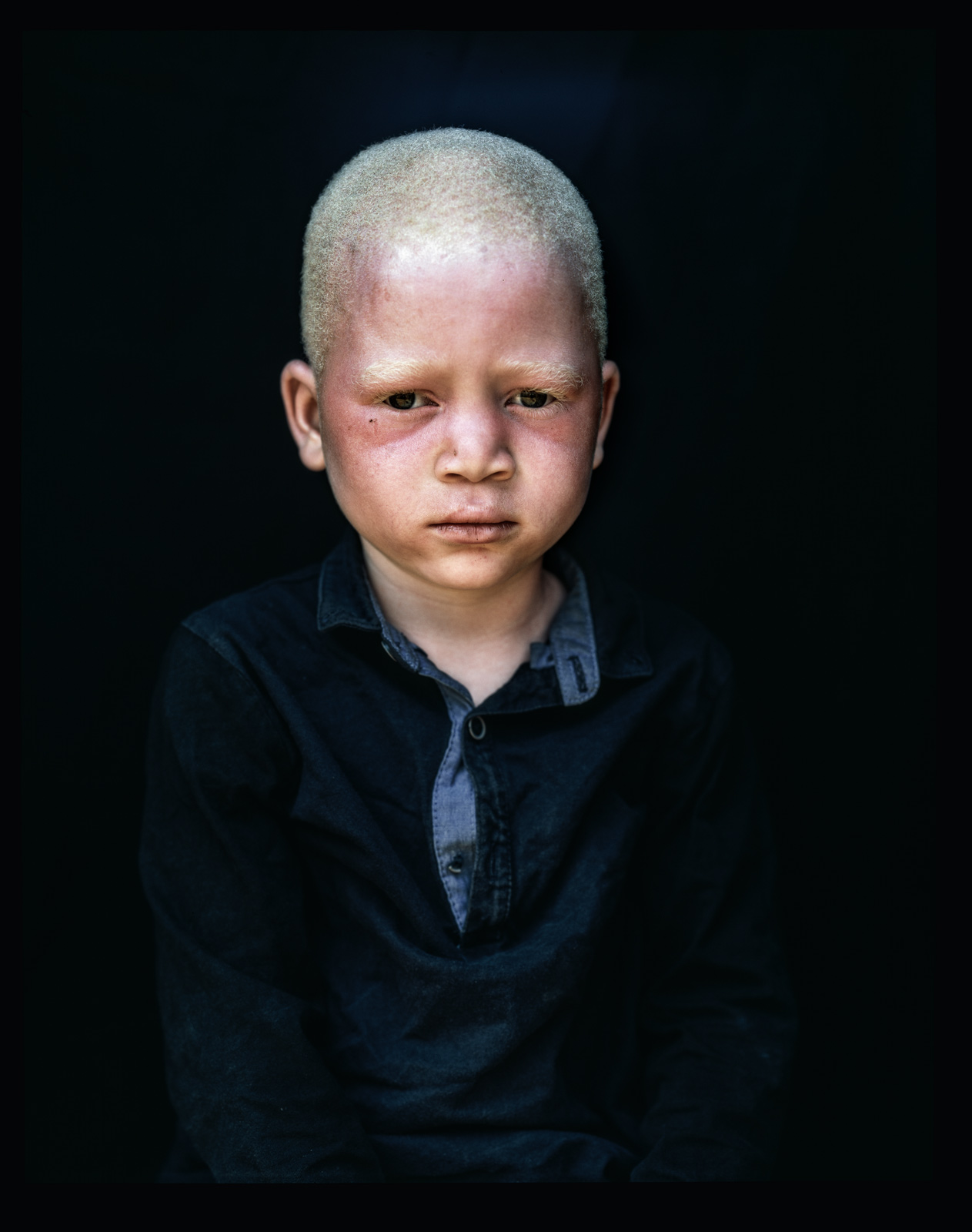 People with Albinism, Malawi